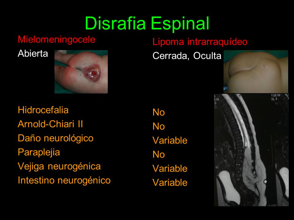 disrafias espinales